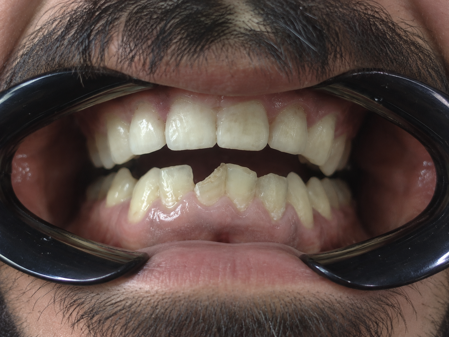After dental treatment