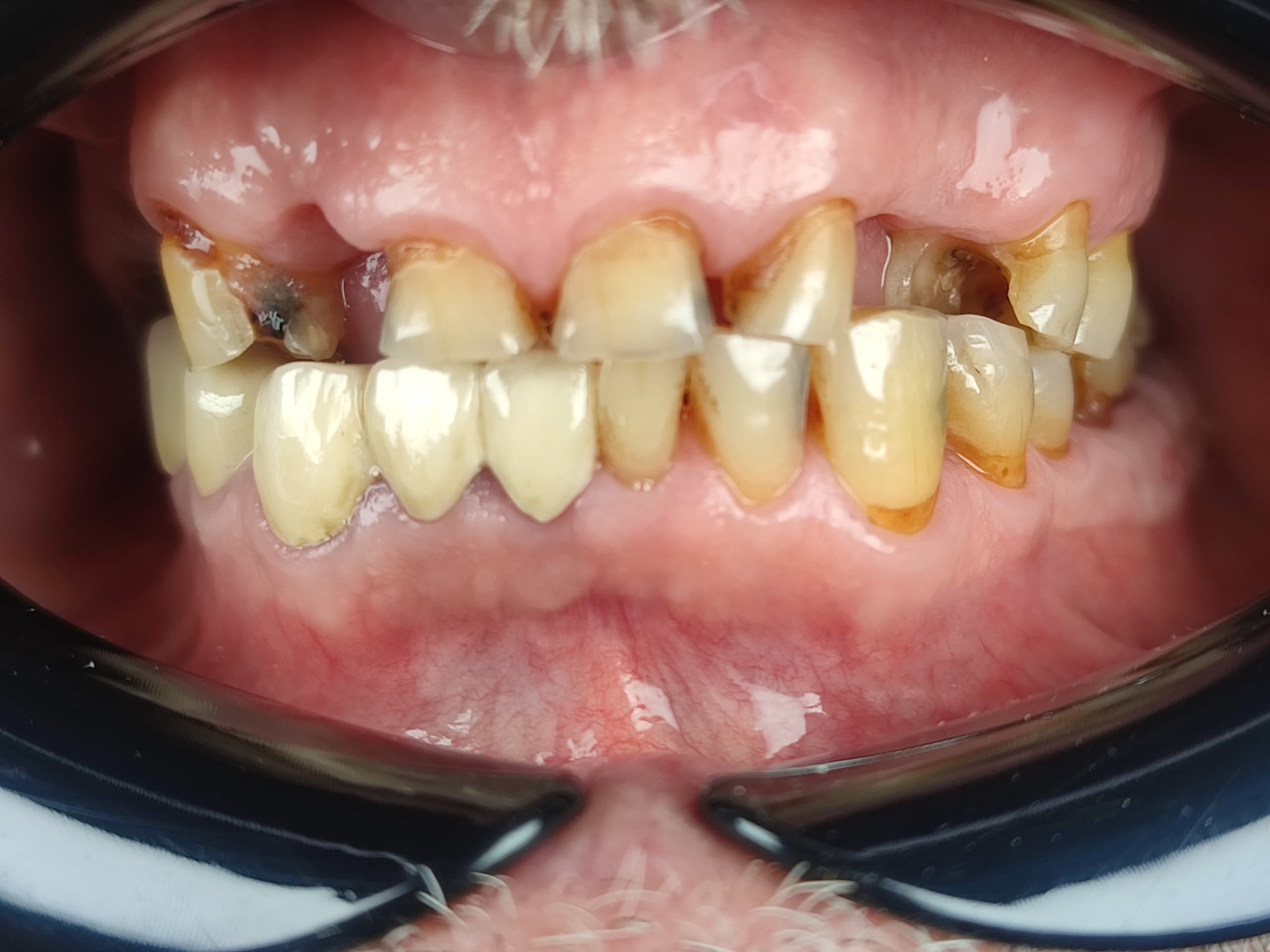 Before dental treatment