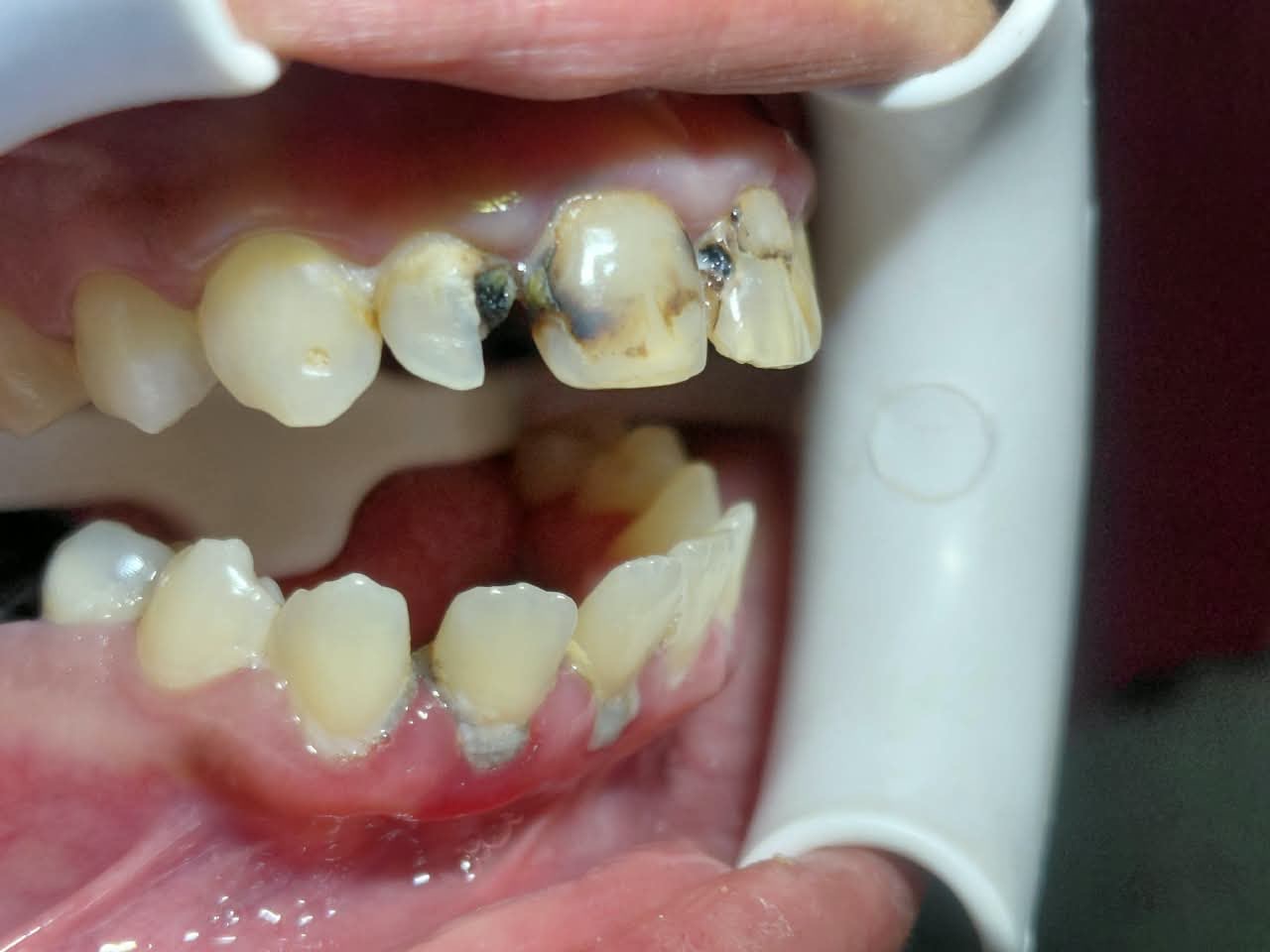 In-progress dental case, before treatment